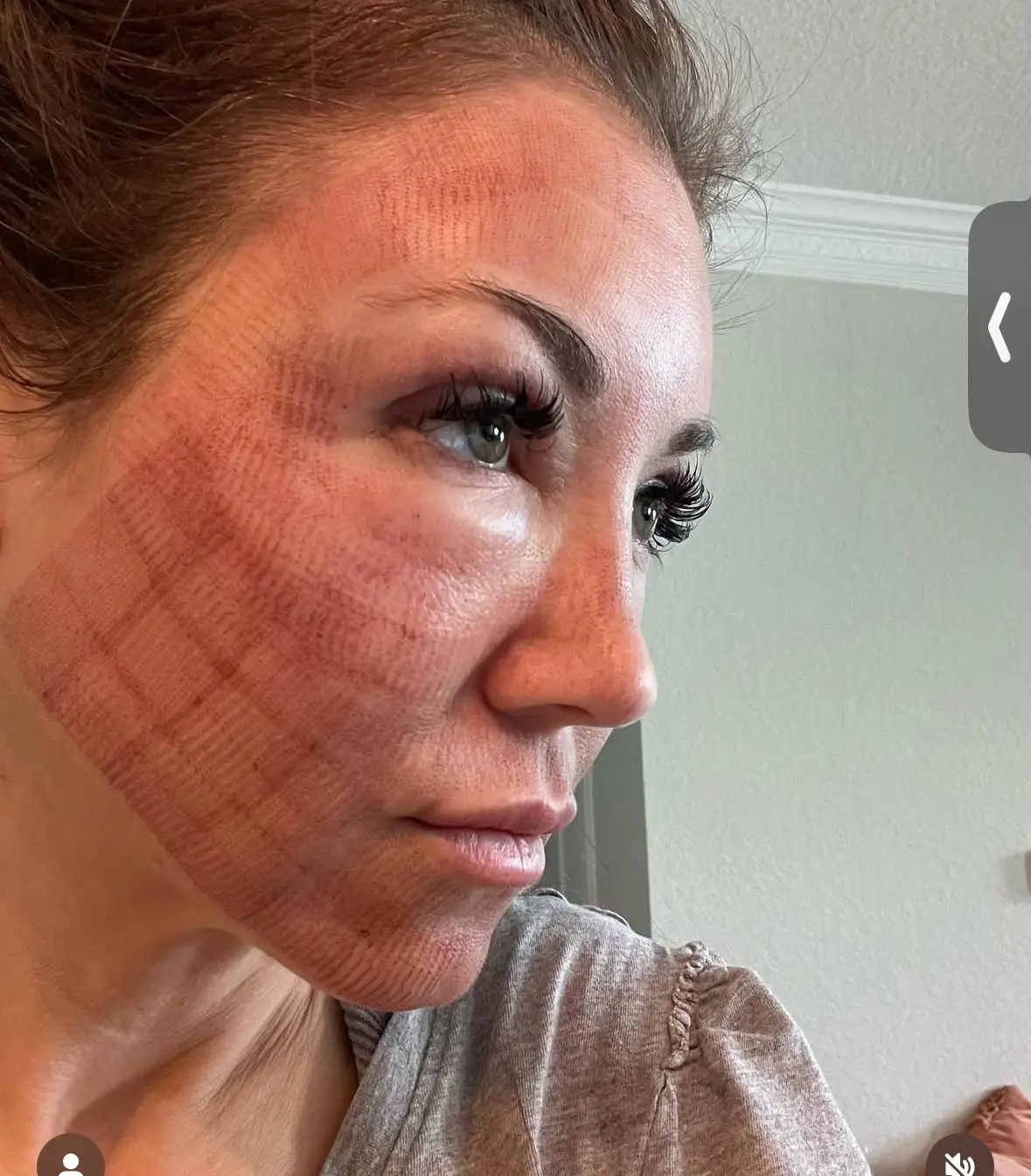 CO2 laser resurfacing grid pattern during the 3–5 day healing stage