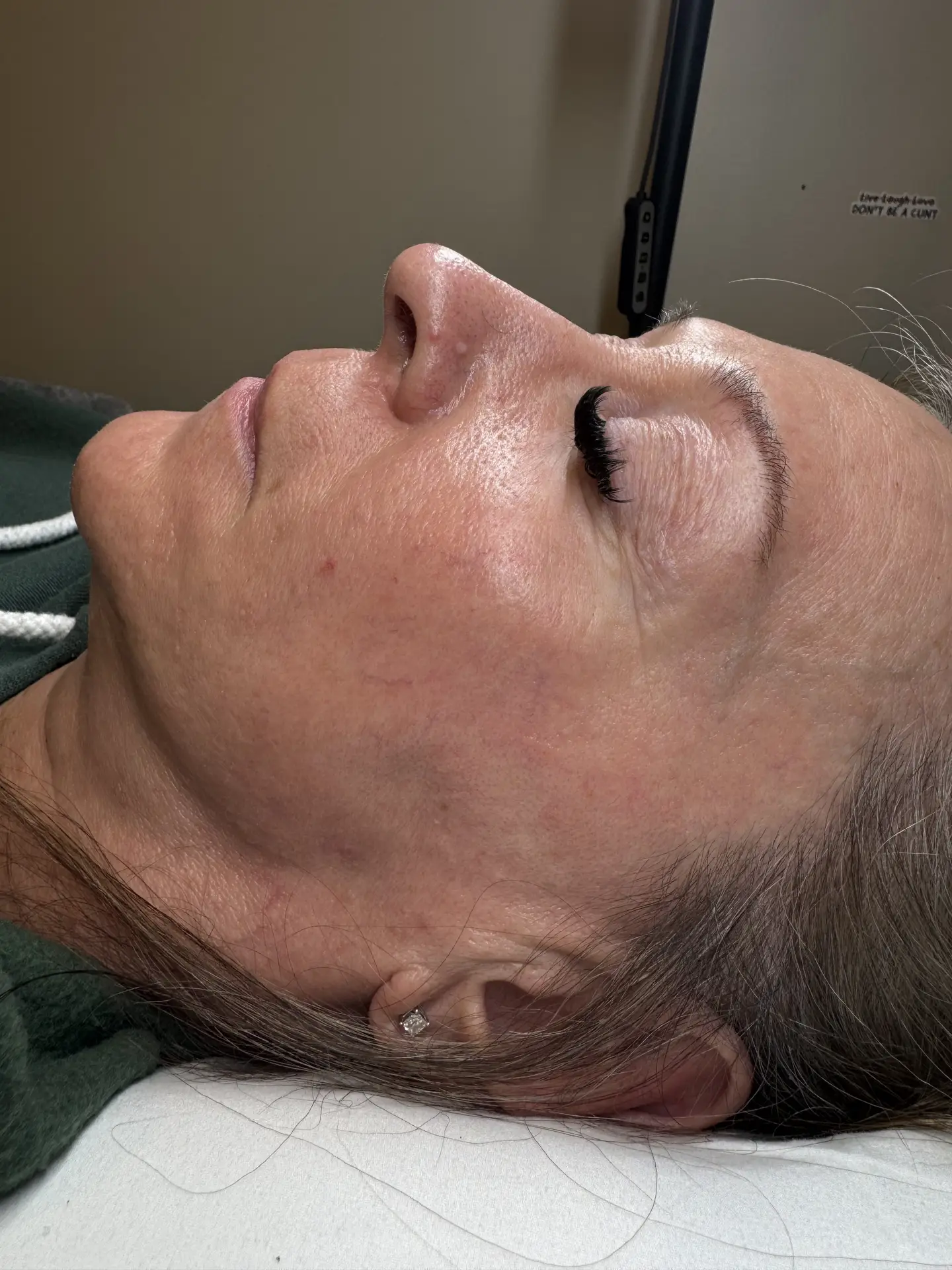 Client receiving a fractional CO2 laser resurfacing treatment at Mazzy Beauty