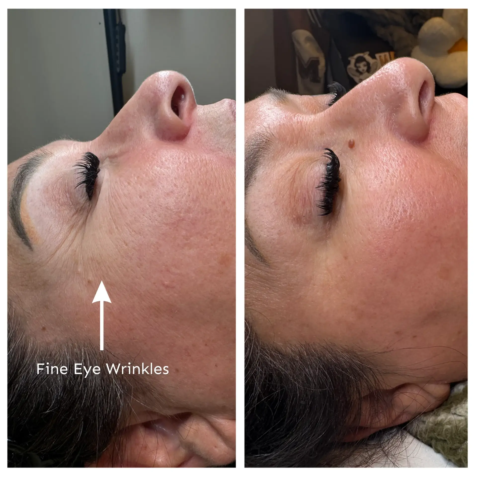 Before and after CO2 laser resurfacing around the eyes