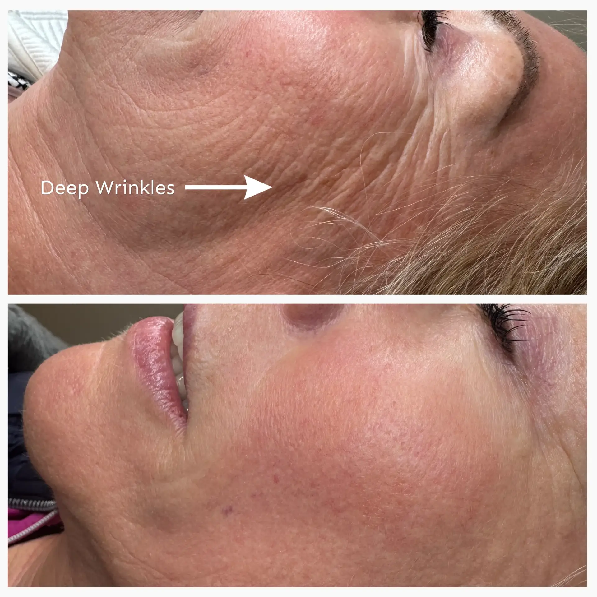 Before and after CO2 laser resurfacing for deeper facial wrinkles
