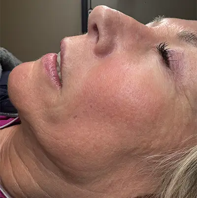 Client skin after CO2 laser resurfacing at Mazzy Beauty