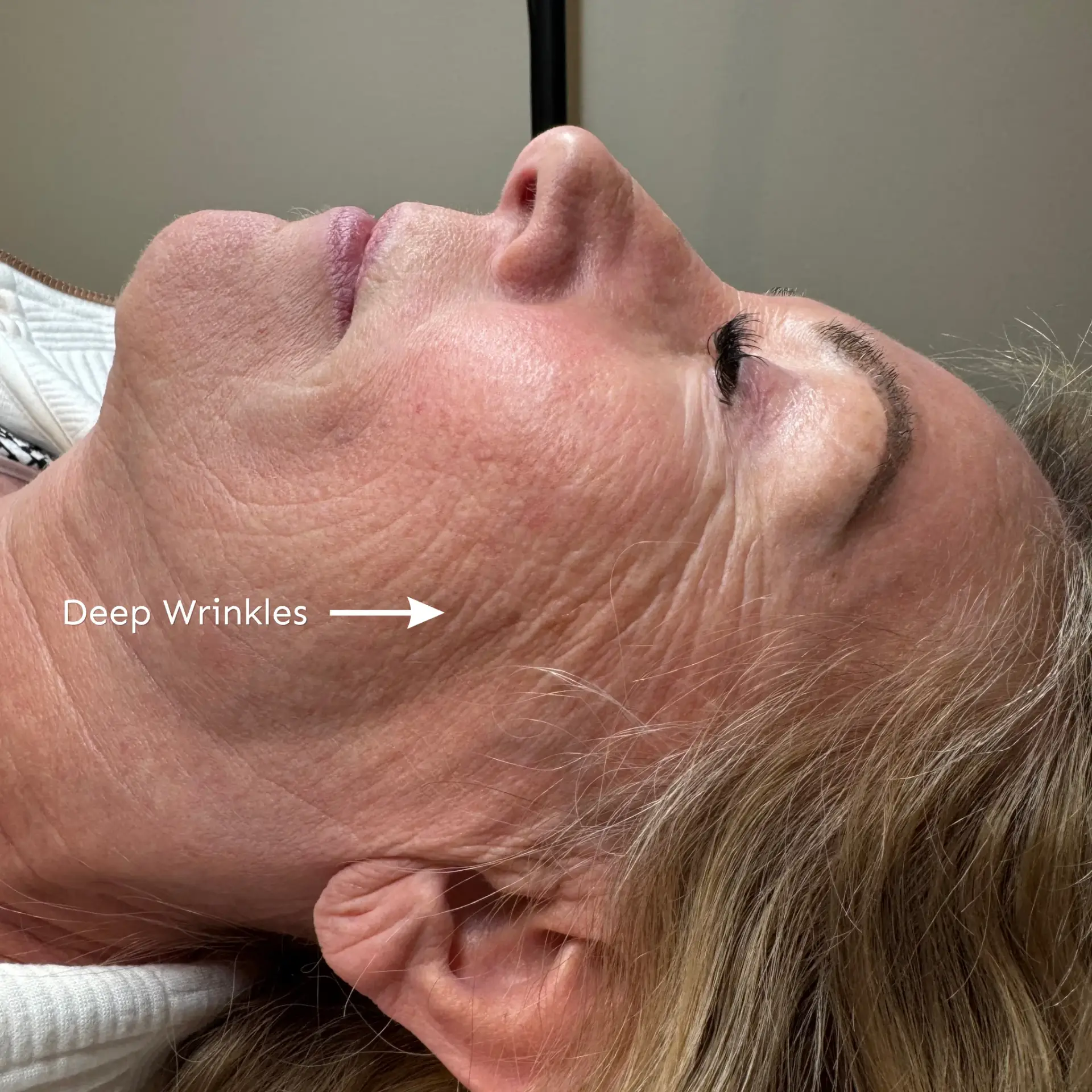 Client skin before CO2 laser resurfacing at Mazzy Beauty