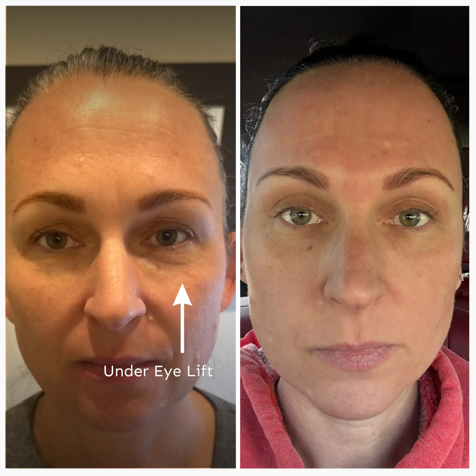 Eyelid tightening and lift from laser resurfacing