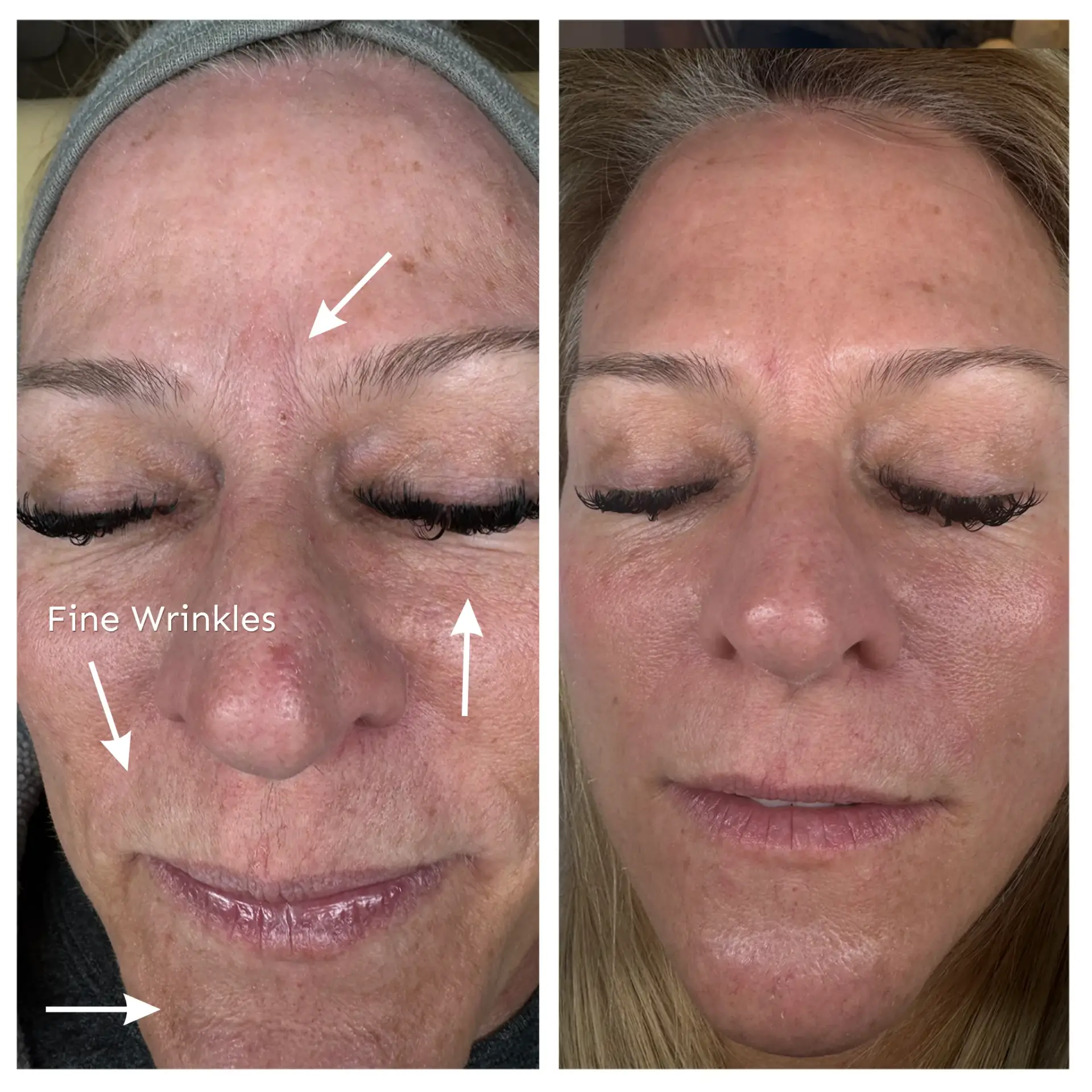 Fine wrinkle reduction result from CO2 laser treatment