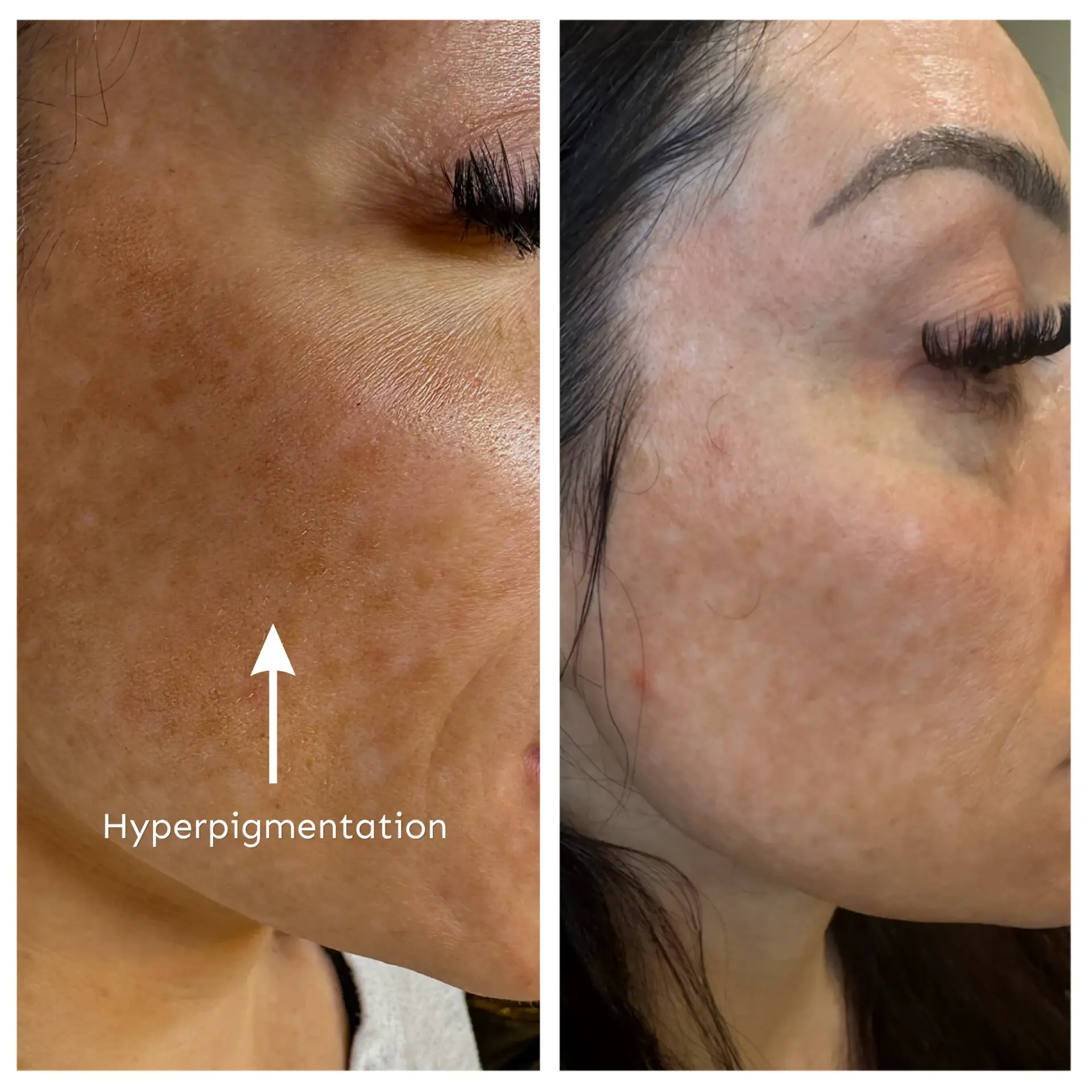 Hyperpigmentation and sunspots reduced with CO2 laser